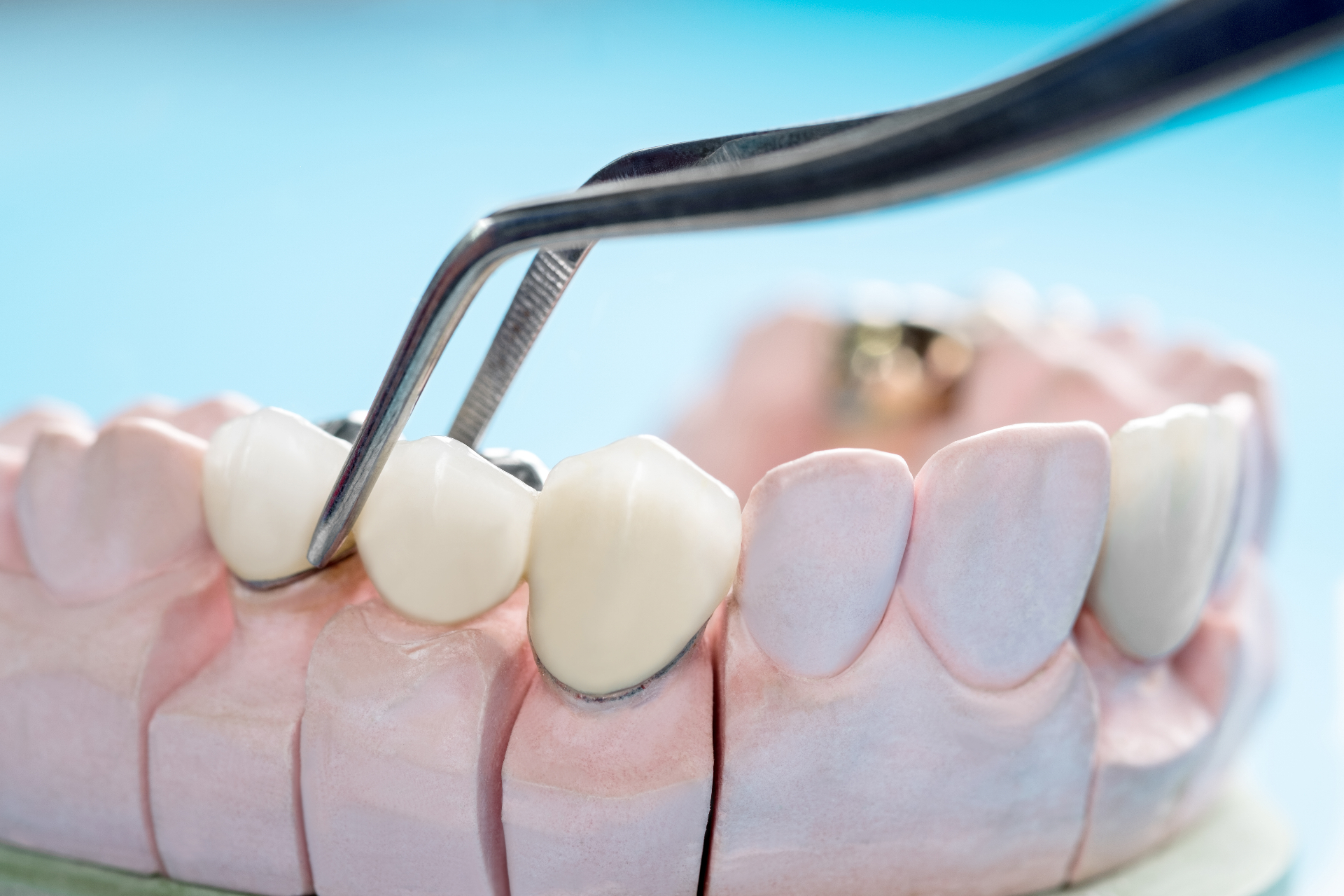 Illustrazione di un ponte dentale fisso con due corone e un dente sospeso al centro