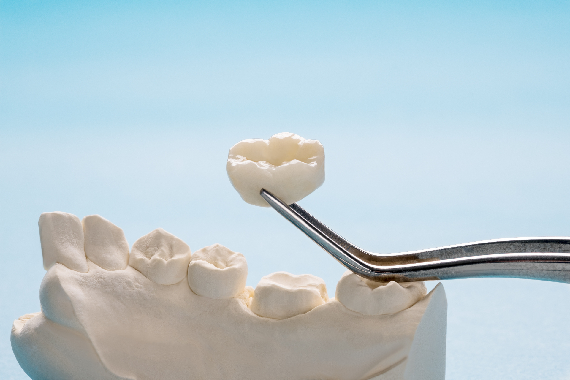 Illustrazione di una corona dentale fissa posizionata su un dente naturale